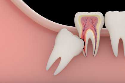 Why Do Wisdom Teeth Need To Be Removed?